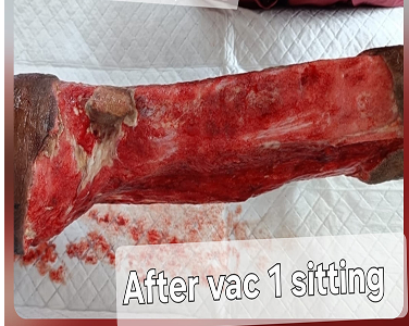 After Negative Pressure Wound Therapy