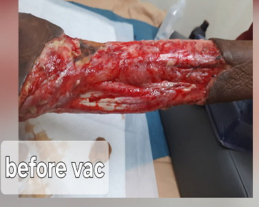 Before Negative Pressure Wound Therapy