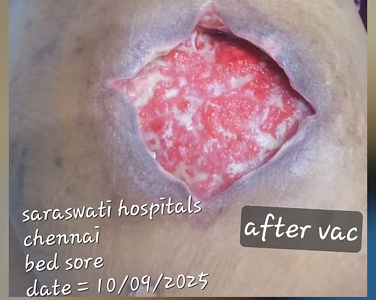 After Specialized Management of Chronic Wounds