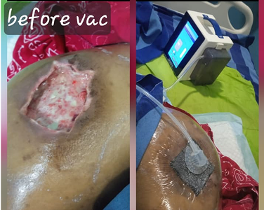 Before Specialized Management of Chronic Wounds