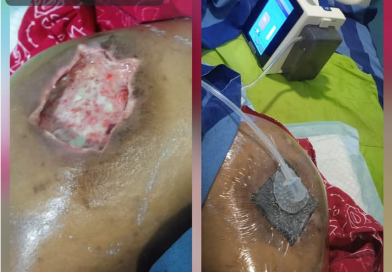 Specialized Management of Chronic Wounds