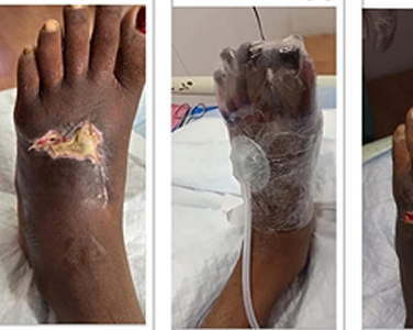Before Negative Pressure Wound Therapy for Diabetic Foot Ulcers