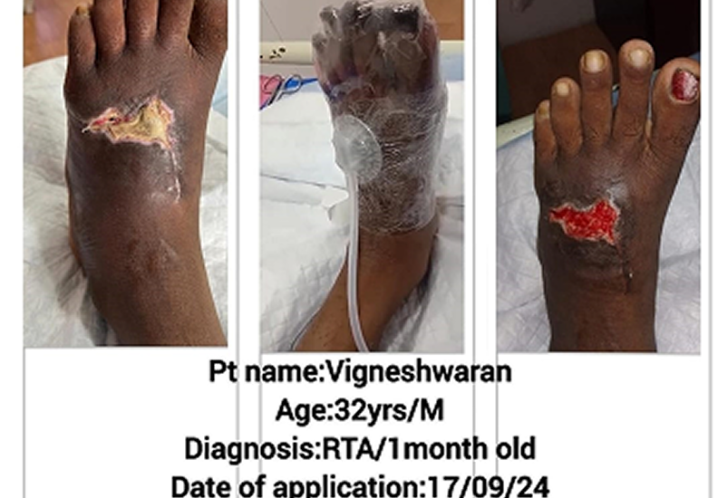 Negative Pressure Wound Therapy for Diabetic Foot Ulcers