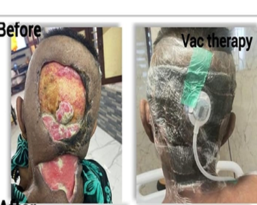 Before Negative Pressure Wound Therapy in Post-Surgical Healing