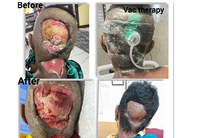 Negative Pressure Wound Therapy in Post-Surgical Healing