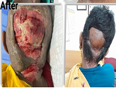 After Negative Pressure Wound Therapy in Post-Surgical Healing