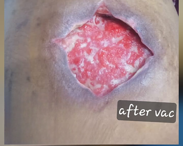 After Specialized Management of Chronic Wounds