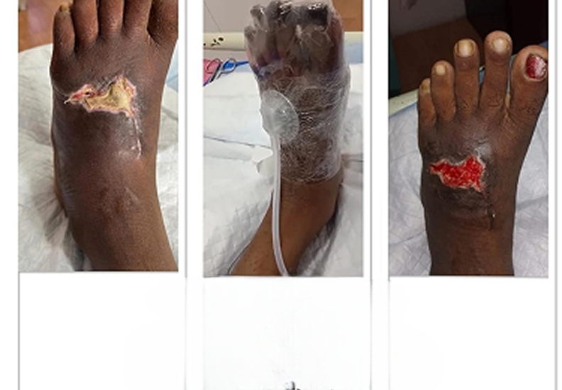 Negative Pressure Wound Therapy for Diabetic Foot Ulcers